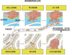 ��֢���߳��ְ�֢ת�Ƶ���Ҫԭ������Щ