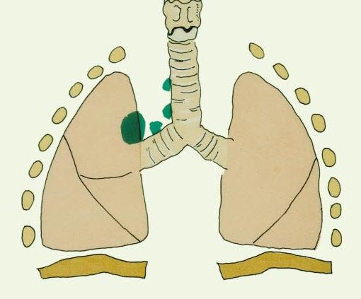 肺癌肝转移 肺癌肝转移