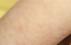 ����;Ϊ��ҽ�������Ҫ������Ƥ����֢״