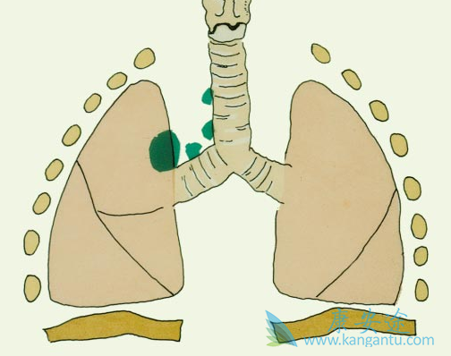 肺癌会传染吗 肺癌会传染吗