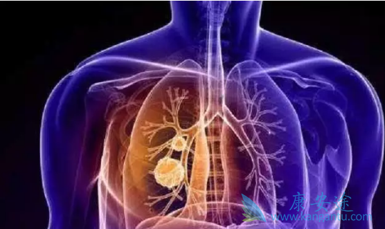 肺癌早期有什么症状 肺癌早期有什么症状