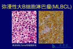 CAR-T�����Ʒ��������Դ�Bϸ���ܰ��������е�Ӧ��