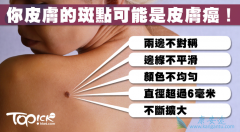 ���ԳƵ������������Ƥ����֢״֮һ