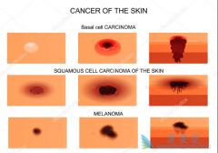 �˽�����Ƥ����֢״�����ھ��緢�ְ�֢��������