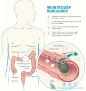 ��Ѫ�Ƿǳ����������ڴ󳦰�֢״֮һ