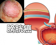 Ѫ��ĳ����ǰ��װ�֢״֮һ