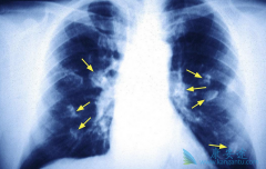 �ΰ��������ƹ�����Ӧע�⻼��Ӫ��Ԫ�ص���ȡ