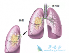 ��Էΰ����ߵĲ�ͬ��֢��ѡ�����Ʒΰ��ķ���