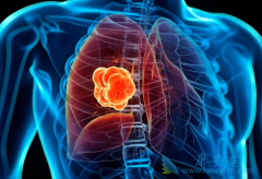 �ΰ���ת��֢״����Щ��ת�ƺ��߻��ܻ��ã�