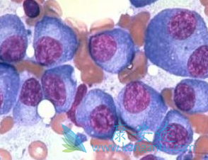 什么是多发性骨髓瘤 什么是多发性骨髓瘤