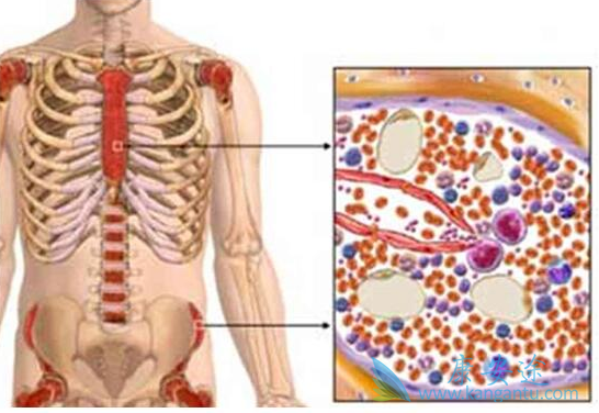 什么是多发性骨髓瘤 什么是多发性骨髓瘤