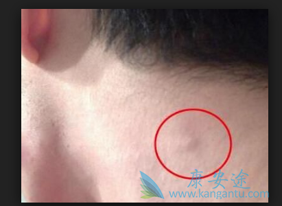 淋巴癌原因 淋巴癌原因