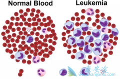 ��Ѫ���Ŵ��𣿳����Ŵ�������Щ���ػ��շ���Ѫ����