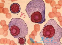 ��֢��ҩ���ǶȰ����������ڹ��谩������Ч����ô����