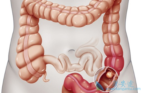 直肠癌症状 直肠癌症状