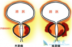 ����ǰ���ٰ�֢״��Ԥ��ǰ���ٰ��ķ���