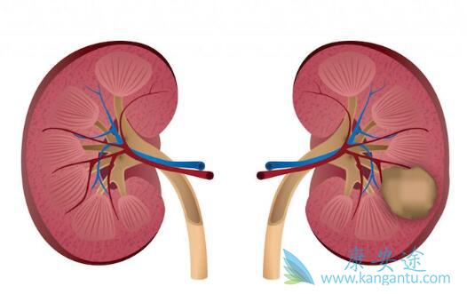 肾癌 肾癌