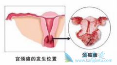 ���ڹ��������߿��Բ���PD-1���Ƽ�Keytruda������