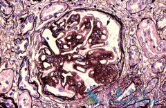 ����������/���޻�����Ĥ�������Ŀ�ͨ��Tregsϸ��Ԥ��