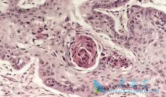 ���۰����߷��ð�������(AFATINIB)���OS��PFS����������