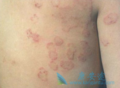 �����ܰͽ��״���Ƥ����֢״����һ��