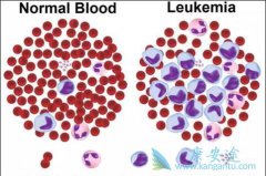 �����жϰ�Ѫ�������費��Ҫ���й�����ֲ