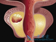 ��������(Abiraterone)���ϱ�׼�Ʒ�������ΪmCRPC������ѡ�Ʒ�