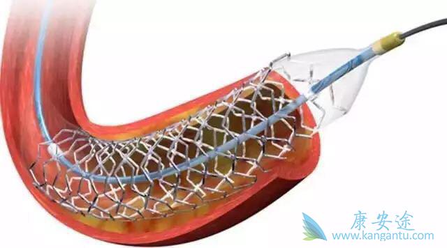 心脏支架 心脏支架