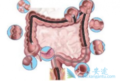 �����鵥��(Bevacizumab)�ܷ�����ת���Խ�ֱ��������