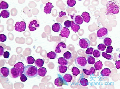 ��³����(IBRUTINIB)������G-CSFRͻ���������Ѫ������Ч����