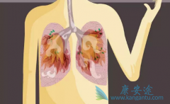 ��������(CRIZOTINIB)��ΰ�֢״�Ļ�������������ĸ����й�