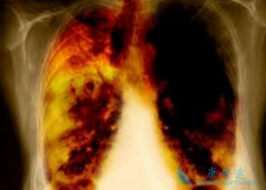 ���÷ΰ�ҩ�Ｊ������(GEFITINIB)������ͣҩ�ļ����ж���