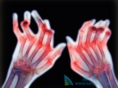 ���޻�/����������¡���岻������ʹ�ڷ�ʪ�ؽ��׻��ߵĸ�Ⱦ�¼�