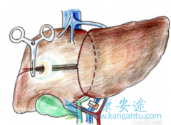 ��������(SORAFENIB)����TACE��������������ΰ�����