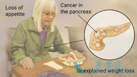 胰腺癌症状 胰腺癌症状