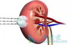 �ҹ��������߷�����������(PAZOPANIB)�ĸ���������������Щ���