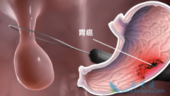 ��Ī¬����(Ramucirumab)����mFOLFOX6�����ܷ����ITT��Ⱥ��PFS