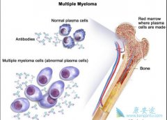 �����ᱻ����Ķ෢�Թ�����֢״����Щ