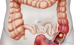 ��ά͡(Avastin)�ͻ��Ƶĳ�������ʱ��������ߵ�Ԥ��Ч��