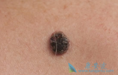 ���޷���(Zelboraf)��MEK���Ƽ����ÿ��ӳٵֿ��ԵĲ���