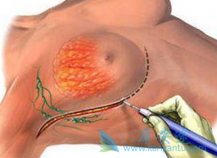 �������ٰ����߷��ð�������(anastrozole)���Ƿ�ά˾Ⱥ