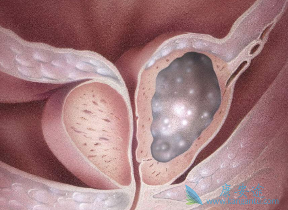 阿比特龙 阿比特龙