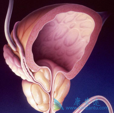 前列腺癌 前列腺癌