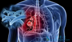 �ΰ�ҩ��̩��ɳ(AZD9291)�����Ʋ�ͬ���͵Ļ���ʱ�÷���ͬ