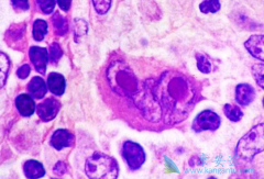 ����ż��ҩ�ﱾ��������(ADCETRIS)��������Ӧ֢����Щ