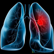 PD-1ҩ����ķ����(Keytruda)��ȡ�����Ƴ�Ϊ���ڷΰ���һ���Ʒ�