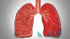 ��������(Alunbrig)��ҩ����Ϊ����ʱ���߻�õ��޽�չ�������