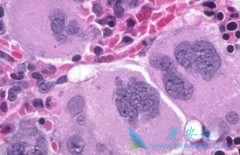 ����³������(ruxolitinib)�ܸ��ƹ�����ά�������֢״��