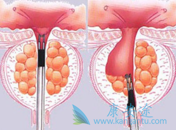 阿比特龙 阿比特龙