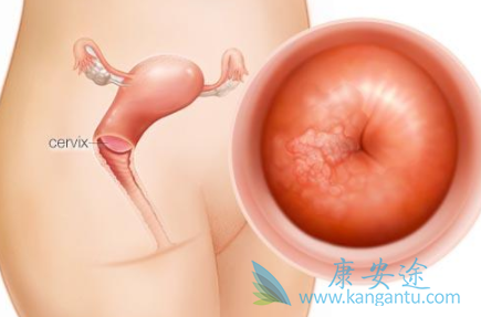 宫颈癌症状 宫颈癌症状